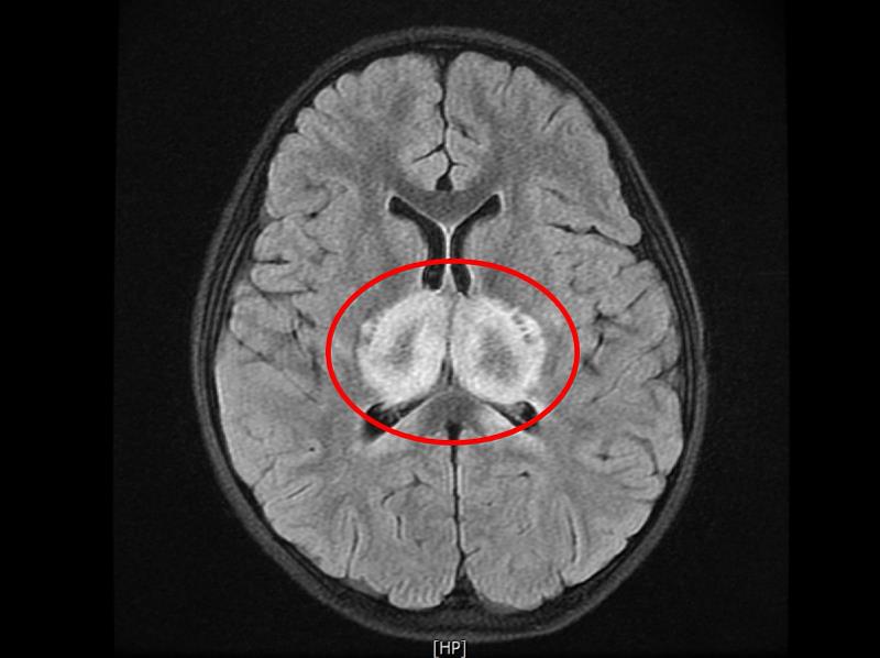 蔡小妹核磁共振掃描影像顯示視丘區域發白，即此區塊正嚴重發炎。