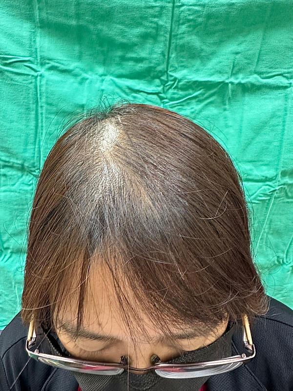 「不是掉髮就一定是雄性禿」，花蓮慈濟醫院皮膚醫學中心主任張中興表示，臺灣女性掉髮最多的原因，超過百分之五十是與缺乏鐵有關。