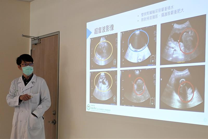 董聖雍醫師分享84歲患者案例，其攝護腺體積140cc，遠超正常人20cc，膀胱更引流出超過1000cc血尿.