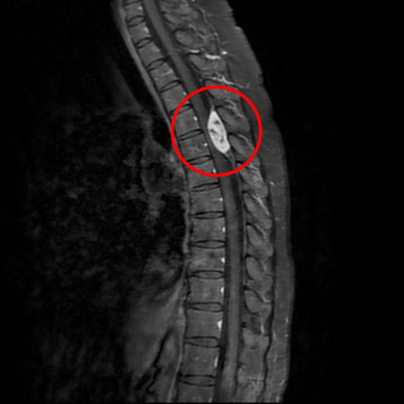 經核磁共振檢查，發現廖小姐的胸椎第四、五節空腔有顆三公分大的腫瘤，已嚴重壓迫神經。
