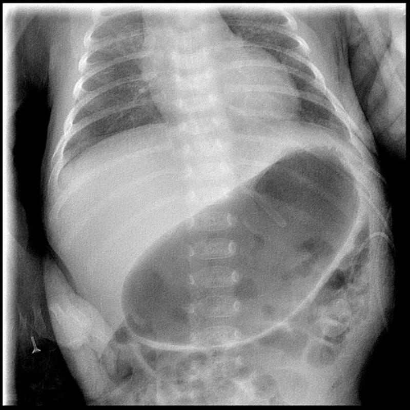 腹部X光顯示寶寶的胃部很脹，無法通過幽門到達十二指腸的食物皆堵在胃裡。