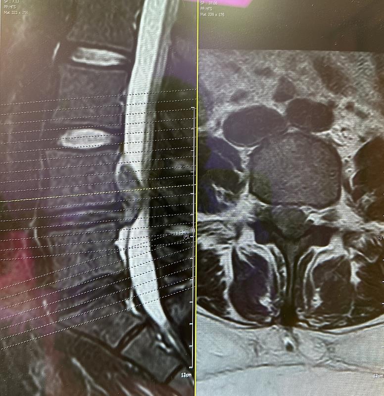 針對椎間盤突出，目前僅透過 MRI 進行影像判讀，無法瞭解內部成分的改變