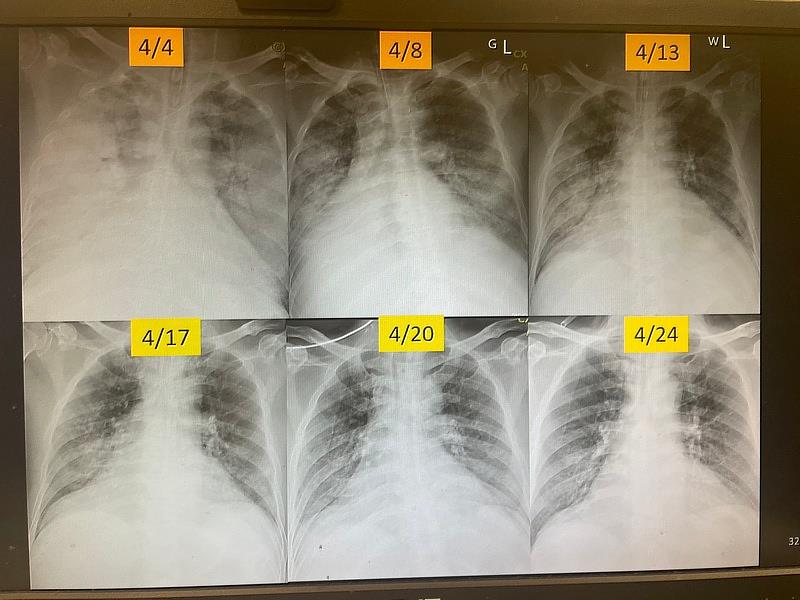 病人治療前與治療後的胸部X光片影像，原本大片白化的肺部(上），治療後恢復正常（下）。