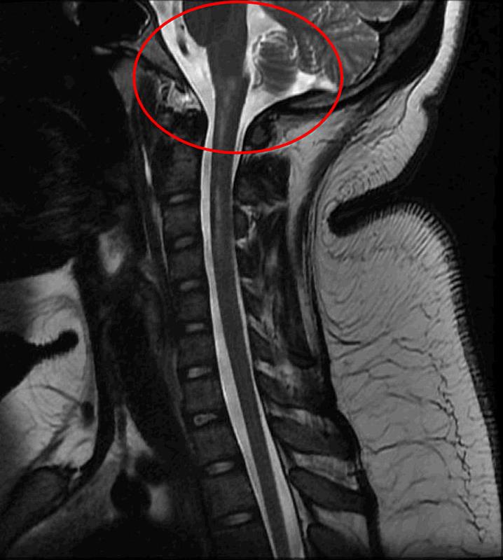 核磁共振檢查顯示，小妤的延腦下方至頸椎上部為明顯的發炎狀態。