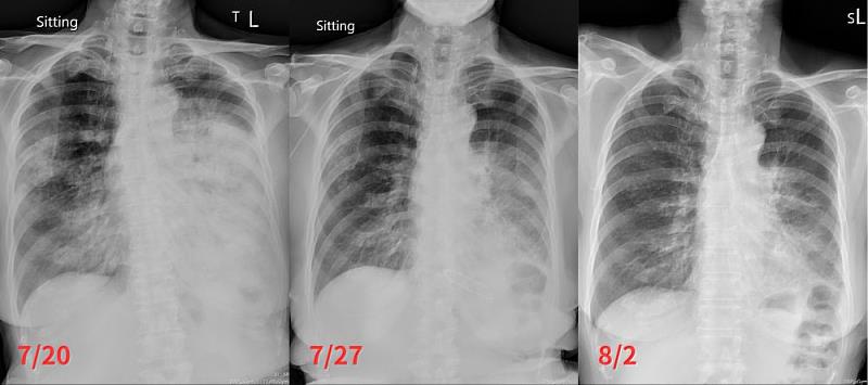 方奶奶於七月下旬轉往花蓮慈院時，X光影像顯示肺部有明顯陰影，經標靶藥物治療五天後已減少許多，治療二週後更僅剩肺葉的一點陰影。
