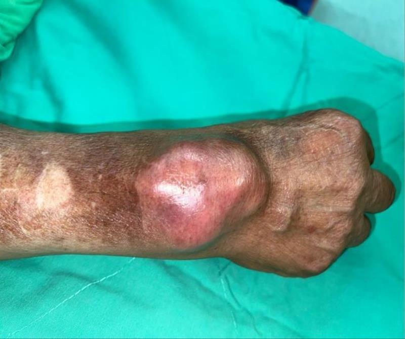 農夫收治整型外科病房，右手臂到手腕有一個大約6X5公分的紅色腫塊。