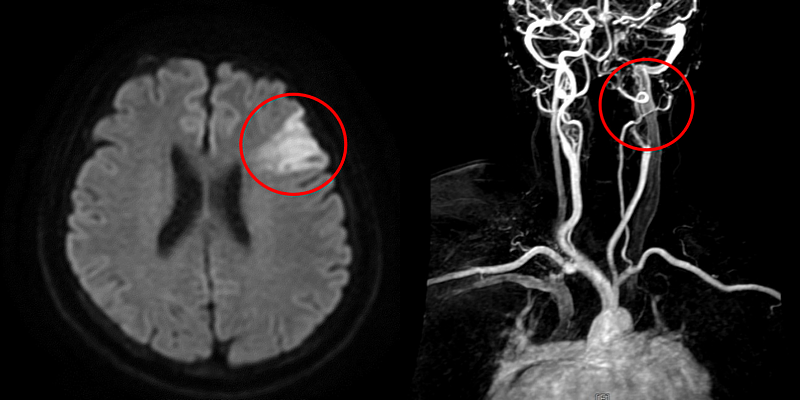 經核磁共振檢查發現左腦有明顯發亮區域，以及缺少了左側內頸動脈的顯影，即確認是左腦急性腦塞與左側內頸動脈完全阻塞。