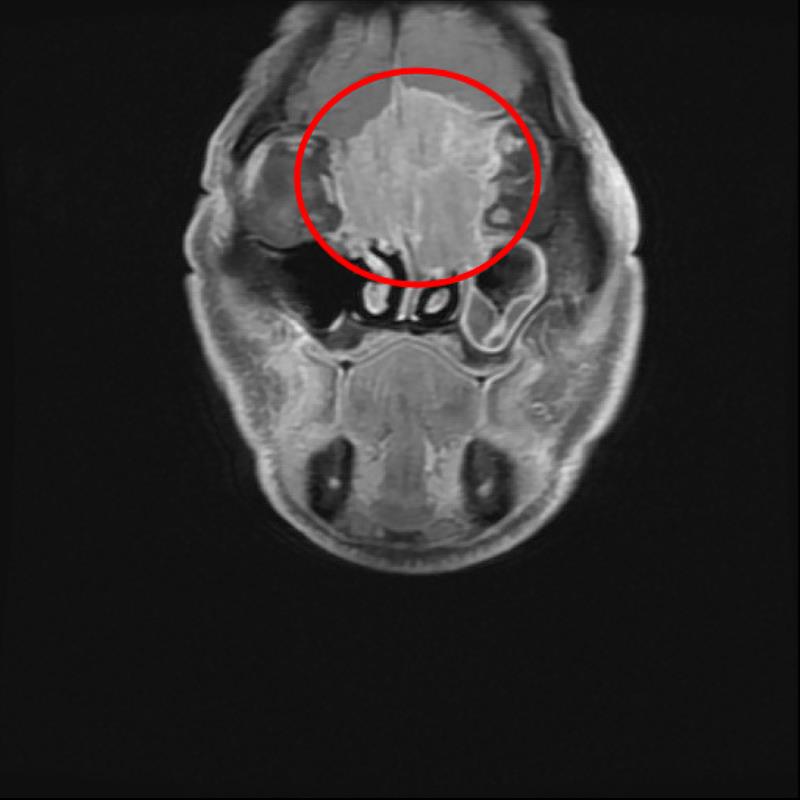 黃先生罹患罕見的「嗅神經母細胞癌」，且腫瘤已長到6公分，從大腦額葉到雙側眼框到鼻腔上部，佔據整個前顱底並侵蝕到鼻樑骨。