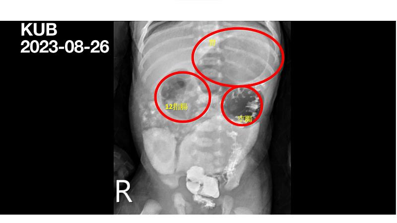 透過腹部X光攝影檢查，可以明顯看出因為腸道造成的腸胃道腫大。