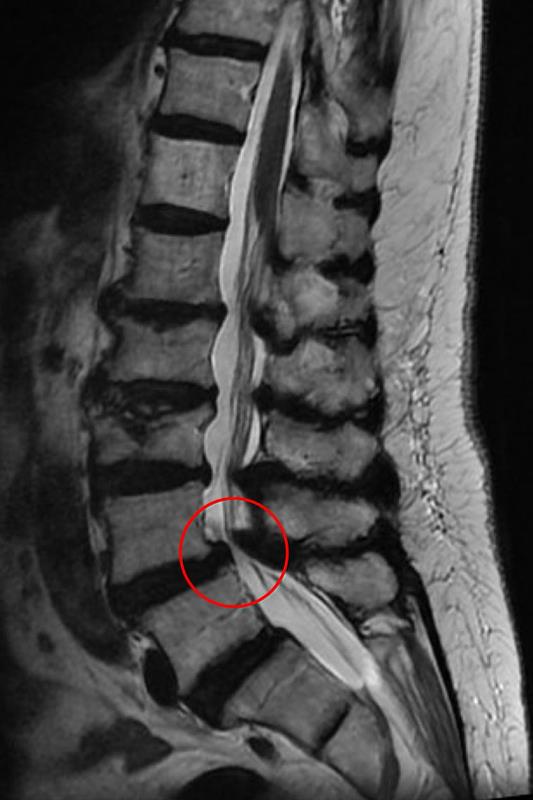 磁振造影顯示腰椎滑脫後因骨刺壓迫造成神經狹窄。