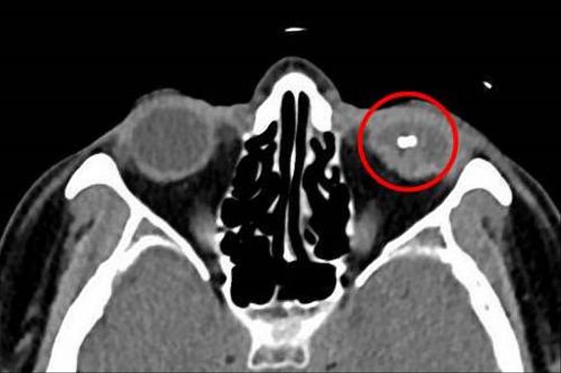 電腦斷層顯示，射入眼睛的金屬鐵片造成眼球破裂變形。
