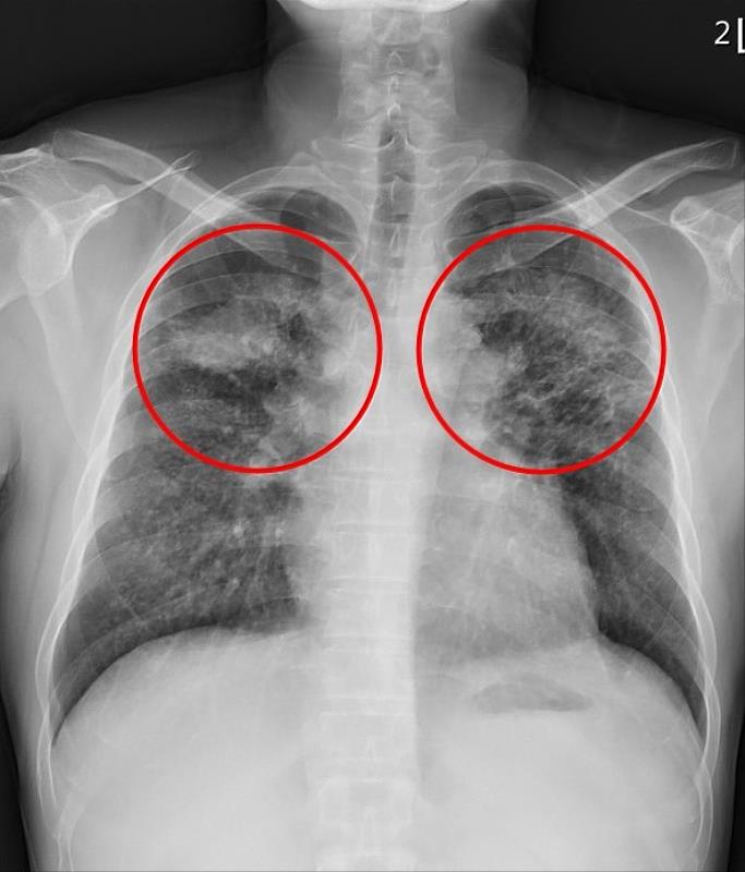 劉迪塑醫師指出，矽肺症患者的肺部因發炎反應和局部纖維化而產生許多間質性結節，嚴重時甚至會發展為漸進性大量纖維化，在雙上肺葉形成對稱的腫塊。