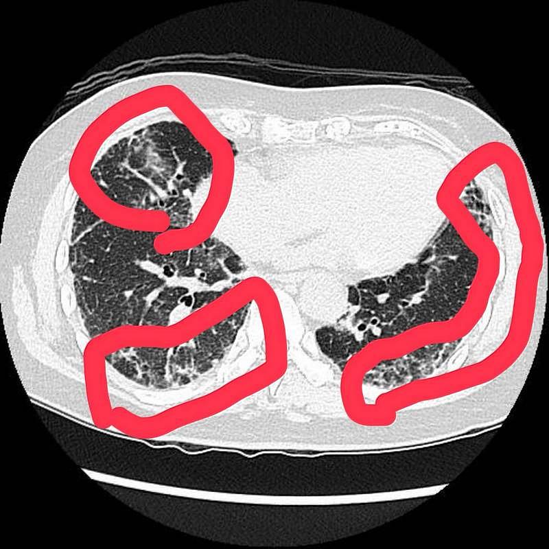潘郁仁醫師表示，王女士電腦斷層影像顯示肺部出現白花花的纖維化症狀，初步診斷為間質性肺病。