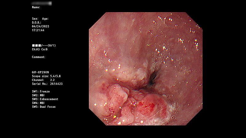 圖為55歲男性食道癌患者，放化療前上內視鏡檢查消化道，發現食道中下段存在腫瘤。