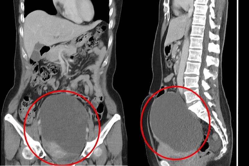 電腦斷層顯示家芸的腹部內有一顆16公分的巨大卵巢腫瘤。