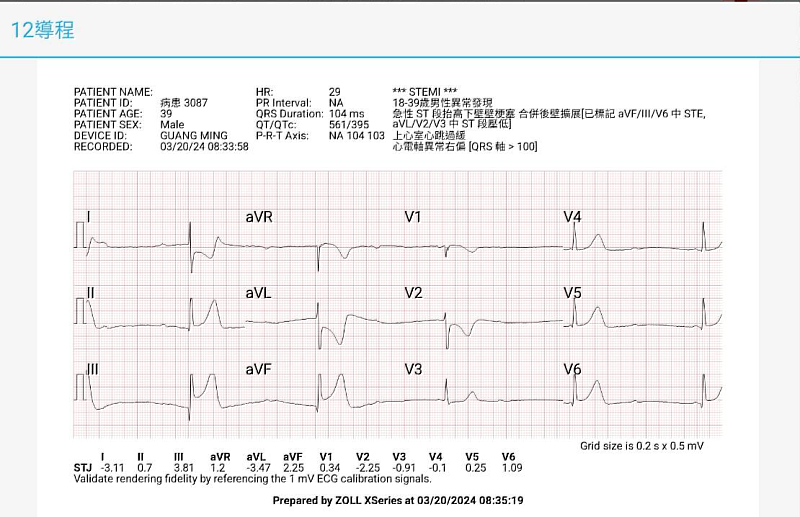 男子心電圖呈現心肌梗塞