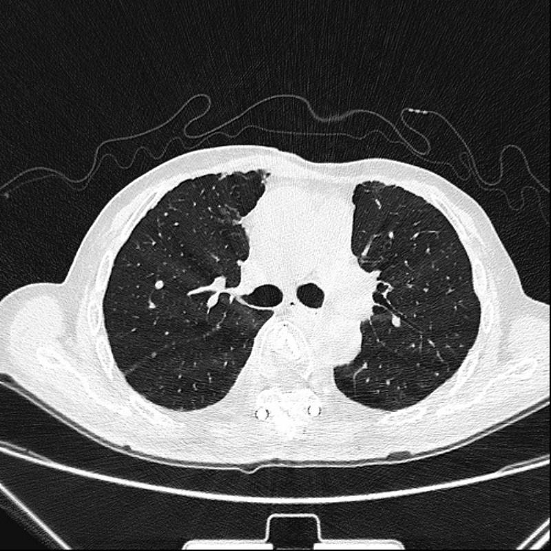 經標靶治療後，電腦斷層顯示肺部轉移病灶已完全消失。