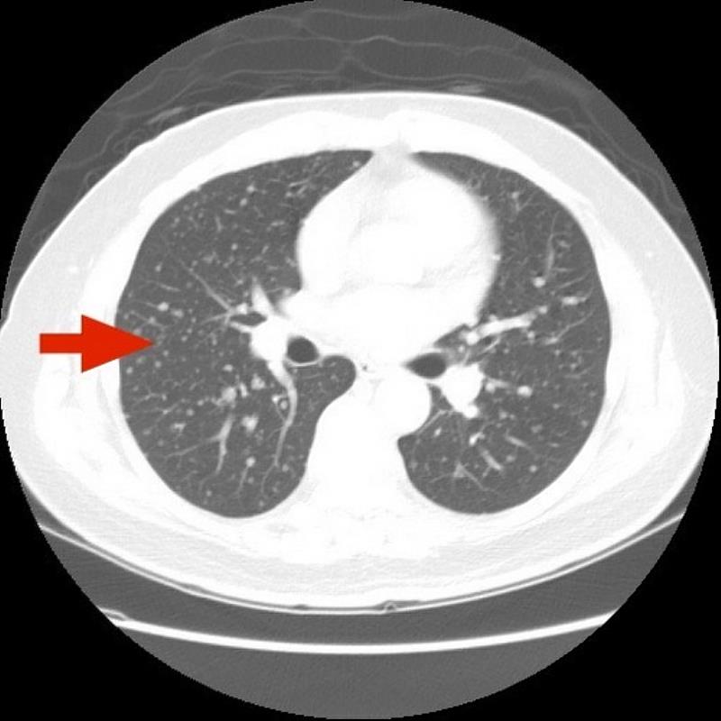電腦斷層顯示，兩肺一度出現瀰漫性轉移病灶。