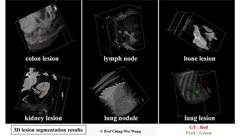 王靖維教授團隊開發通用AI模型精準3D分割多類別病灶，紅色輪廓代表基準真相；綠色輪廓代表模型預測。
