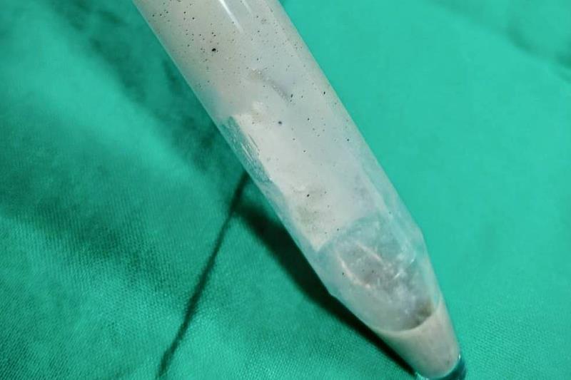 第一次支氣管鏡檢查，清理出不少混有泥沙細石的濃痰。