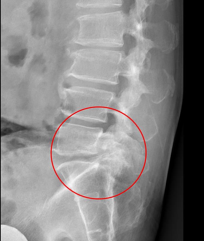影像檢查顯示，張先生的第五節腰椎椎弓骨折合併脊椎解離。