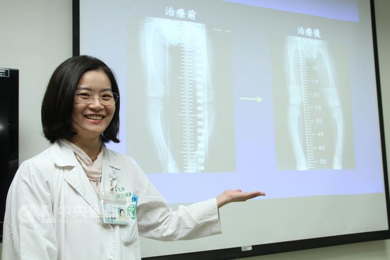 奇美醫學中心兒科部兒童內分泌科主任王碩郁表示，孩童持續下肢變形可能是佝僂症導致。缺乏鈣質及維生素 D的營養性佝僂症可以預防，家長應多注意。 中央社記者楊思瑞攝 105年12月15日