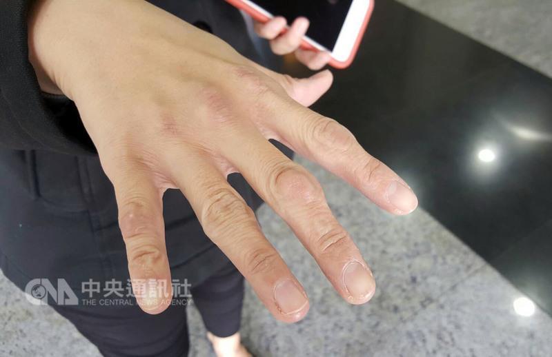 家族性高膽固醇血症是全球最常見的家族性遺傳疾病， 成因是患者的基因突變影響膽固醇代謝機制，導致體內 低密度脂蛋白膽固醇（俗稱壞膽固醇）濃度變高，身上 膝蓋、手肘、或腳後跟等多處可能長出脂肪瘤。 中央社記者陳偉婷攝