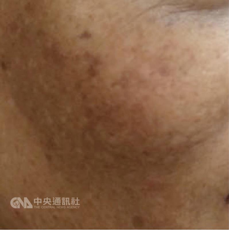 1名50歲吳女士日前去掃墓，忘記防曬，回家後臉上一 片黑，自行買美白產品「淨膚」，結果臉上黑出兩片「 黑豬肝」。醫師提醒，更年期女性更要注意防曬，以免 肝斑上身。 （醫師黃雍宗提供） 中央社記者陳偉婷傳真