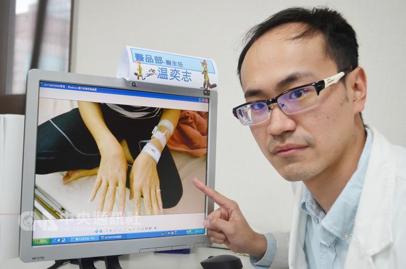 台中市澄清醫院中港院區胃腸肝膽科主治醫師溫奕志發 現，一名越籍女子因感冒而服用同鄉提供的草藥秘方， 引起皮膚搔癢及變黃，診斷是藥物性急性肝臟衰竭。 （醫院提供） 中央社記者郝雪卿傳真 106年6月12日