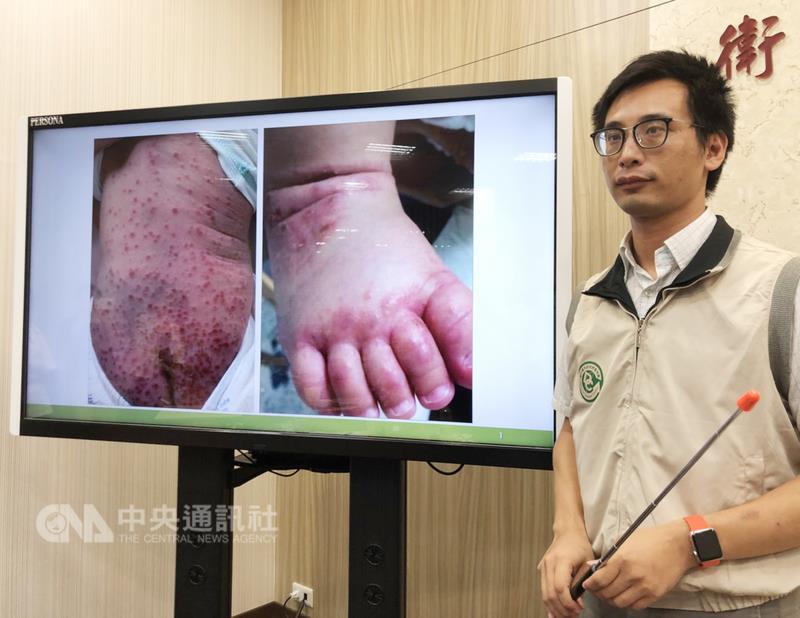 疾管署17日舉辦疫情週報，指出上週腸病毒疫情雖已趨緩，但仍未脫離流行期。防疫醫師鄭皓元（圖）表示，近期有許多孩子全身冒水泡或長滿小紅疹，是腸病毒克沙奇A6型常見症狀，嚴重度不高，家長不必驚慌。中央社記者張茗喧攝 106年10月17日