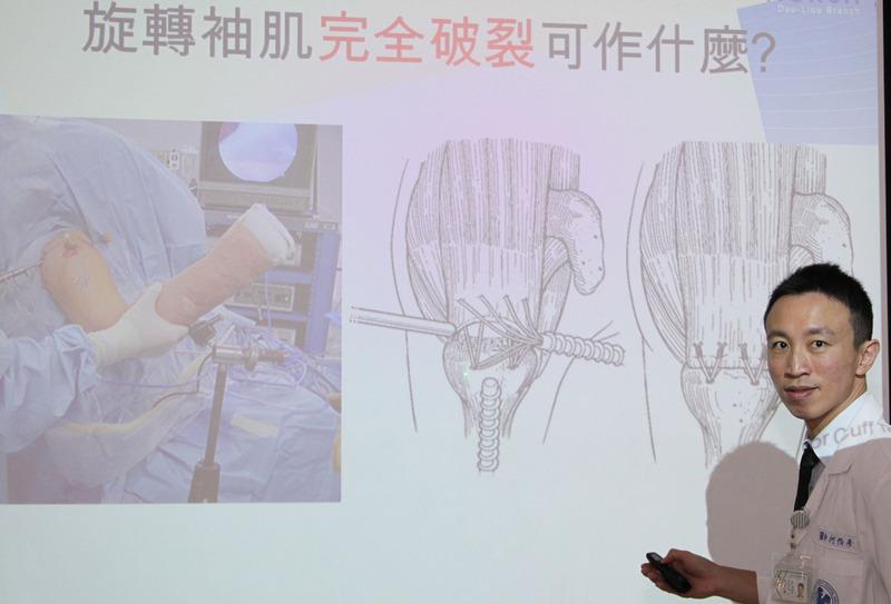 舉手過肩疼痛　醫：旋轉袖肌發炎或破裂
國立成功大學醫學院附設醫院斗六分院骨科醫師柯伯彥
11日指出，舉手過肩疼痛，不一定是五十肩，有可能是
旋轉袖肌發炎或破裂，50歲以上是好發族群，發現症狀
應及早就醫診治。
（院方提供）
中央社記者葉子綱傳真　107年7月11日