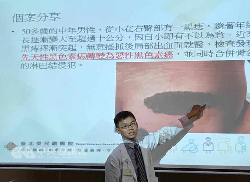 台北榮總皮膚部醫師李政源（圖）20日發表病例，一名在工地上班的50多歲男子，從小右臀有塊黑痣，隨年長和曬太陽，黑痣大到10公分仍不以為意，直到搔癢出血，才發現是先天性黑色素痣轉變為黑色素癌，錯失早期治療機會。中央社實習記者池羽婕攝　107年8月20日