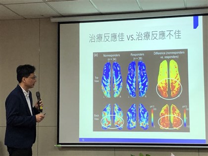 腦波分析提升偏頭痛療效 台灣研究成果登國際期刊