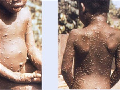 英國新增37例猴痘 與確診者接觸應隔離21天