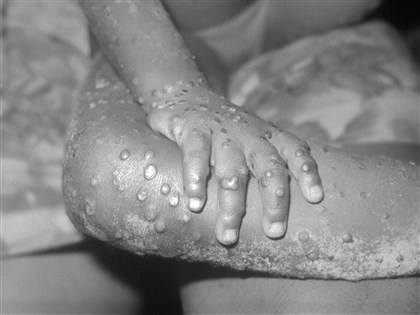 非洲今年通報1597起猴痘疑似病例 66例死亡