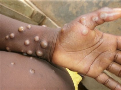 新加坡出現猴痘為今年東南亞首見 韓國也疑有2例