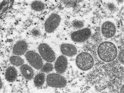 早安世界》台灣首見猴痘病例 男子返國發紅疹 19接觸者暫無症狀