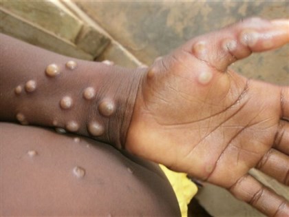 美國首見2起兒童猴痘病例 可能被家人傳染