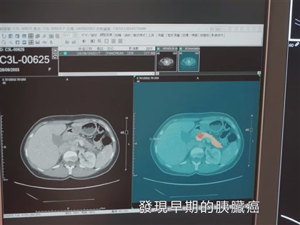 台灣首創AI胰臟癌偵測系統 獲美FDA突破醫材認定