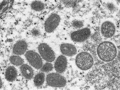 猴痘台灣死亡首例 30多歲男病發3個月後不治