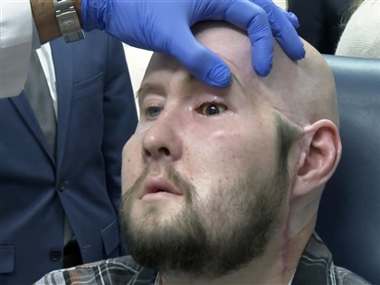 世界首例全眼移植手術 美國工人遭電擊毀容可望重見光明