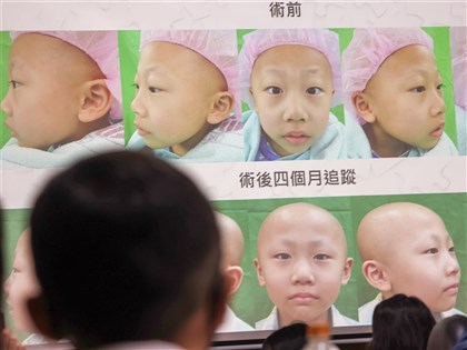 6歲童右臉長惡性瘤 3D列印人骨拼圖重建拾笑顏