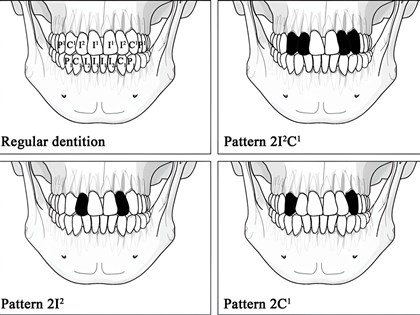 遠古台灣常見禮儀拔牙 研究揭4800年前流行拔門牙犬齒顯美感