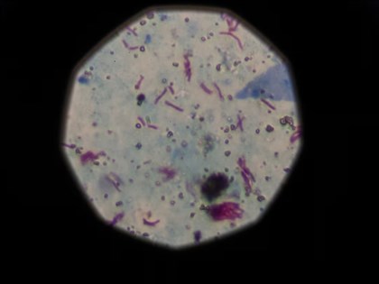 WHO：結核病取代COVID-19 成全球頭號傳染病殺手