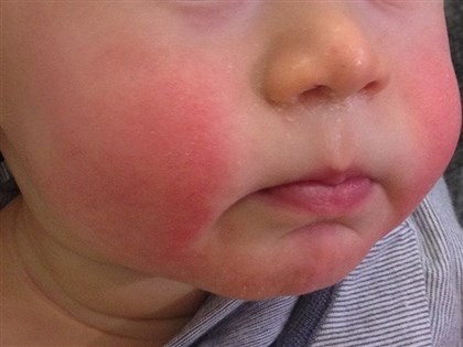 「蘋果病」微小病毒B19是什麼？傳染方式、如何預防一次看懂